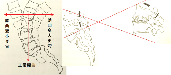 我们发现，异常人体力学状态，改变了腰椎曲度，进而导致了椎间盘突出。腰椎曲度的改变，都会使得椎间盘的前