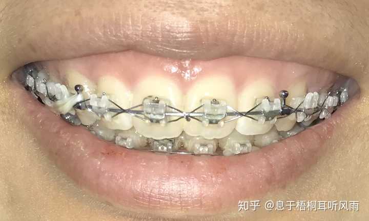 25 岁后去矫正牙齿 戴牙套 是什么体验 知乎 25 岁后去矫正牙齿 戴牙套 是什么体验 知乎