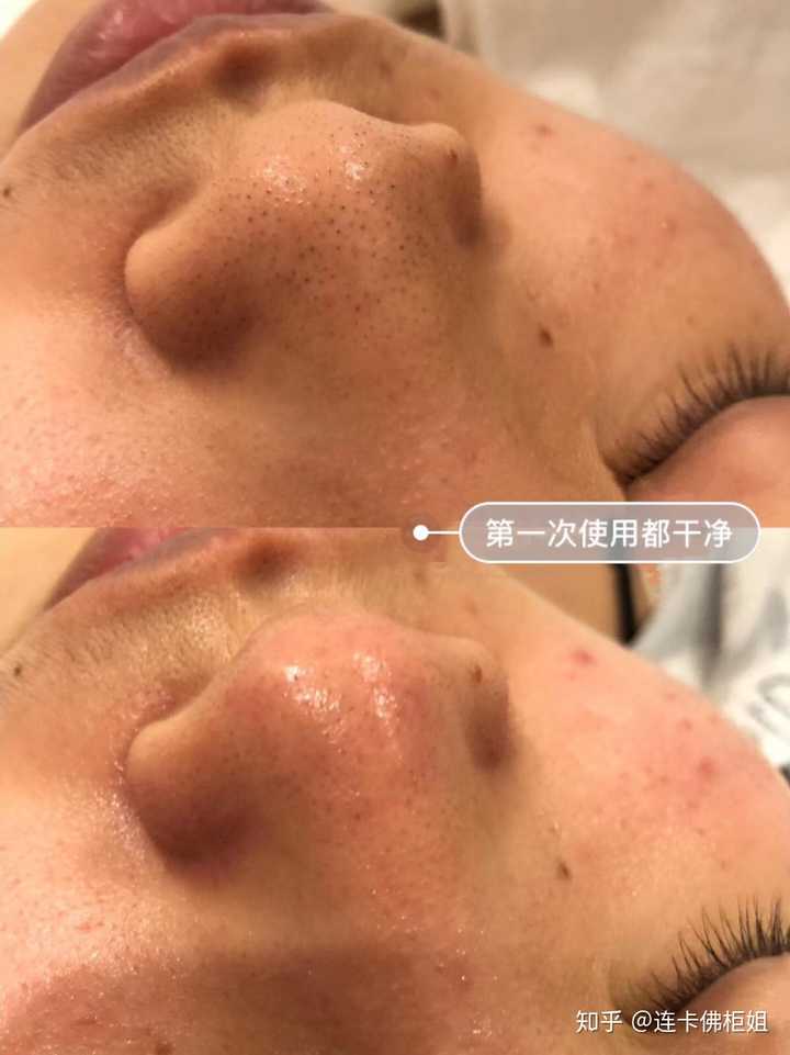 挤黑头应该如何处理留下的洞洞?