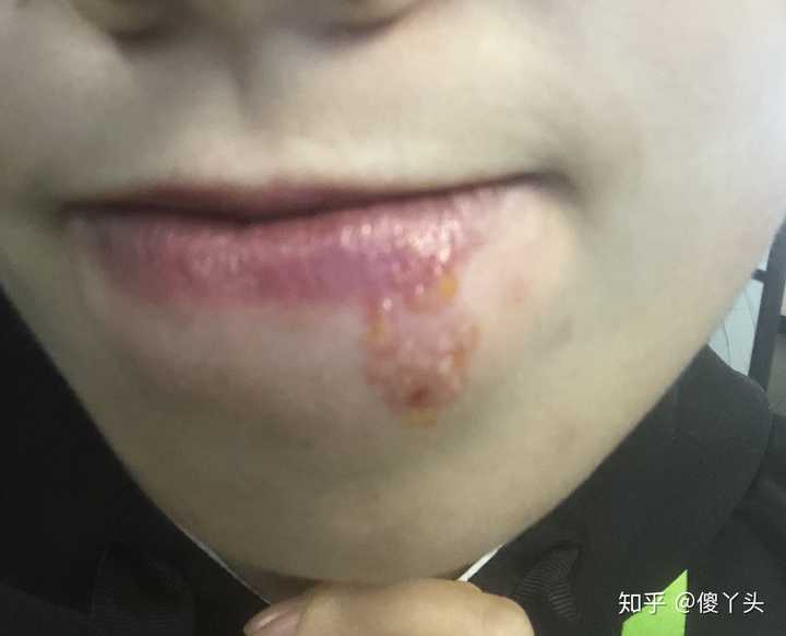 之前上火嘴角起泡好了以后嘴角就留下一块红色的几个月了都不消什么