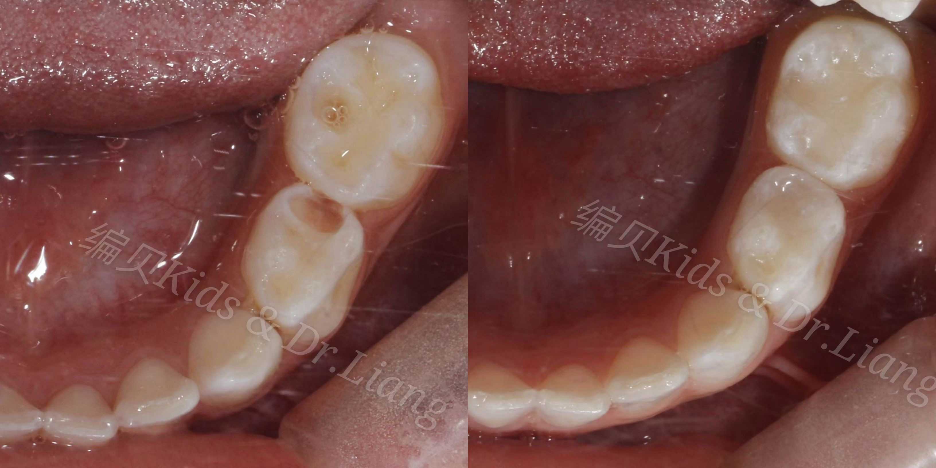 牙齒矯正肖家良 的想法: 鄰面齲在臨床上非常多見,由於發生在牙齒