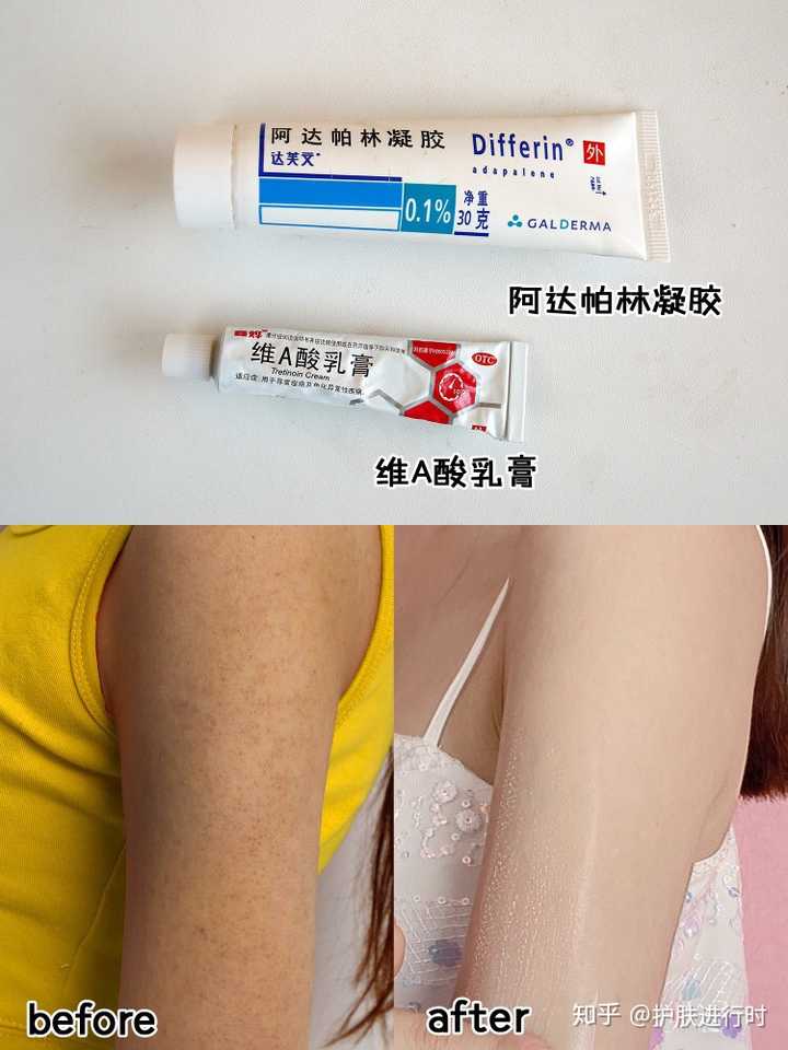 用完维a酸乳膏鸡皮肤(用维a酸乳膏鸡皮肤严重了) 用完维a酸乳膏鸡皮肤(用维a酸乳膏鸡皮肤严重了)