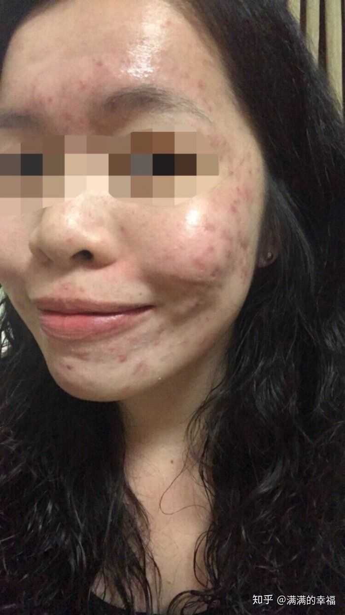 怎样去痘痘 消痘印 知乎 怎样去痘痘 消痘印 知乎