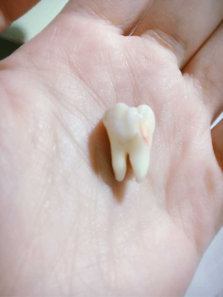 两颗都为阻生智齿,不疼,需要拔掉吗?难度系数大吗?