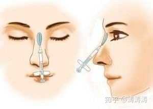 隆鼻后鼻梁有点歪怎么办 知乎 隆鼻后鼻梁有点歪怎么办 知乎