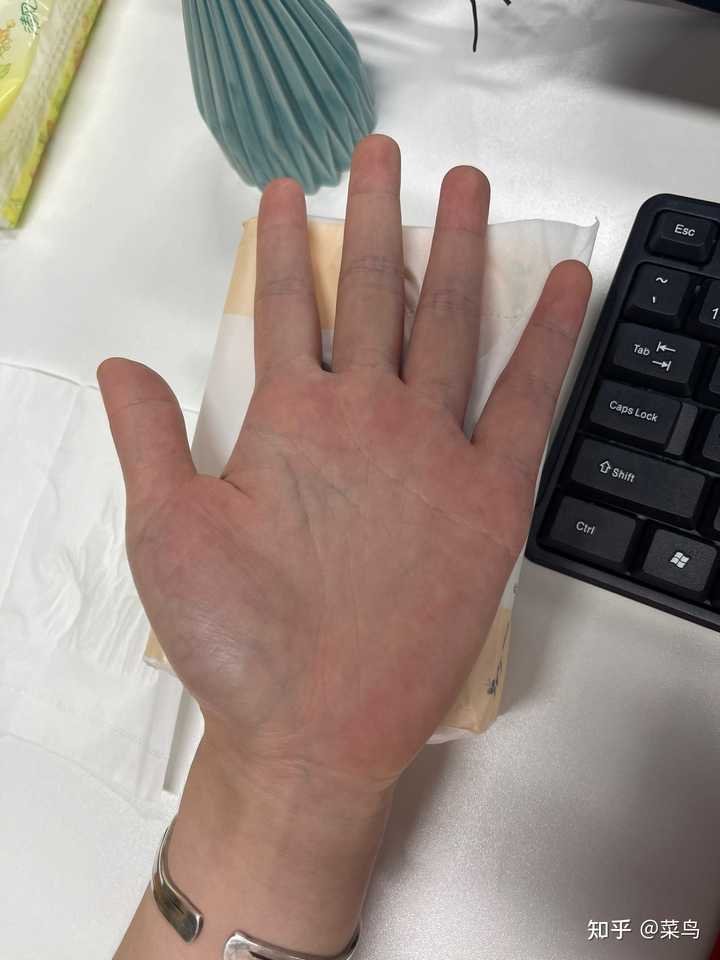 为什么我的手背上静脉血管那么明显 如何改善 知乎 为什么我的手背上静脉血管那么明显 如何改善 知乎