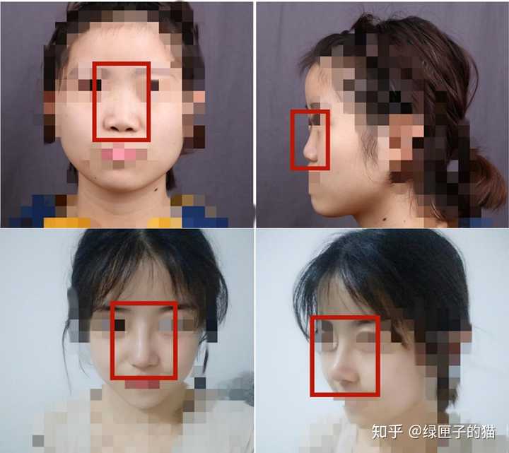 有在上海做过隆鼻的吗 戴传昌怎么样 知乎