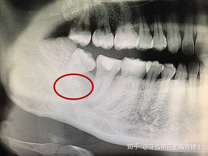 6,智齒阻生:通常這是最麻煩的一種.這一