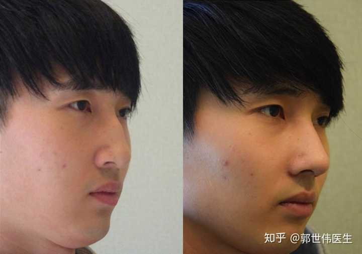 鼻骨内推和鼻头鼻翼缩小有多大风险 知乎