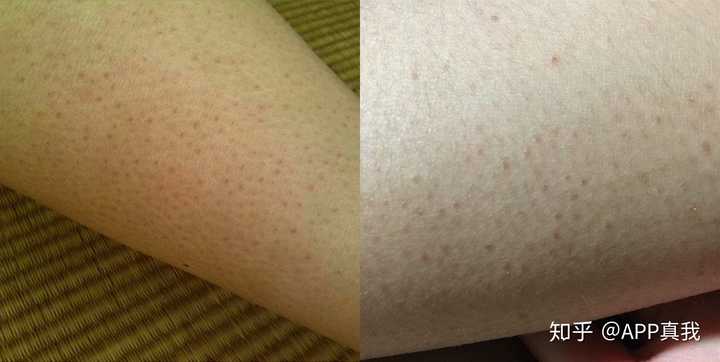 鸡皮肤软化角质有效吗(鸡皮肤软化角质有效吗知乎) 鸡皮肤软化角质有效吗(鸡皮肤软化角质有效吗知乎)