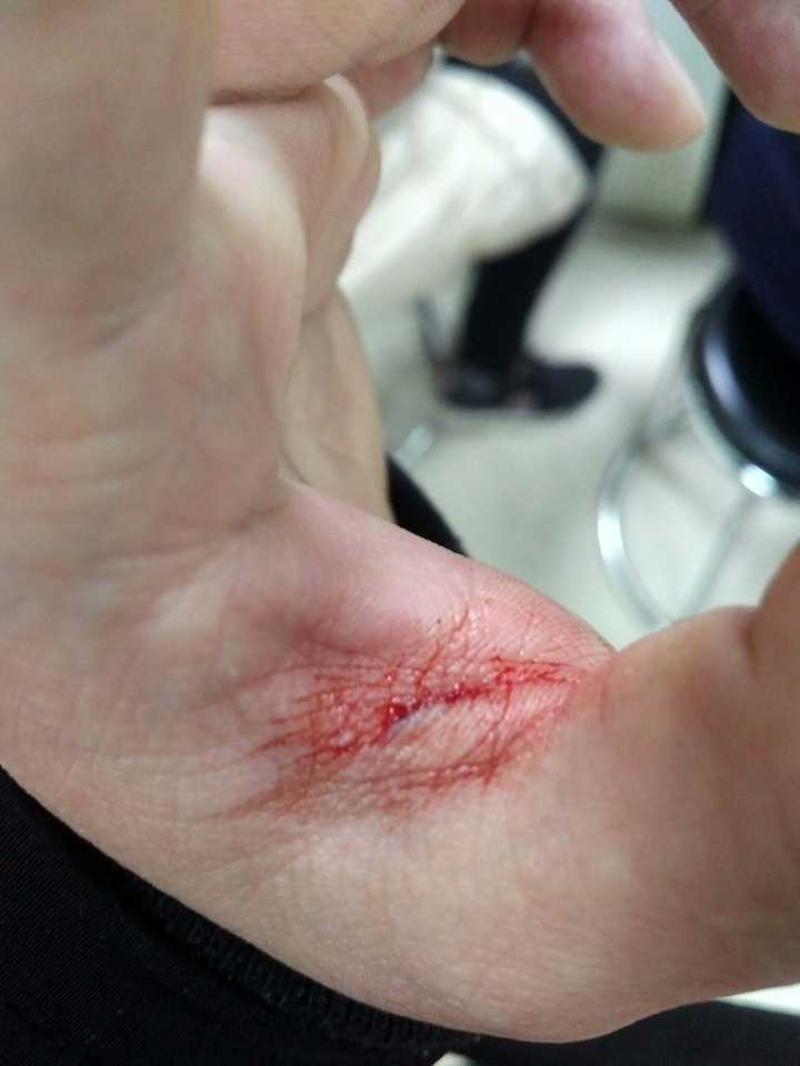 缝针时你是否会选择打麻药? - 知乎