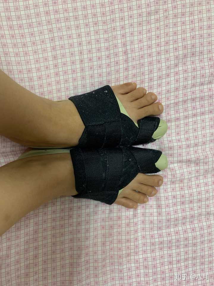女生脚趾拇外翻是什么样体验?