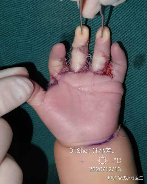 沈小芳医生 的想法: 七个月的孩子波兰综合征我们可以根据皮肤