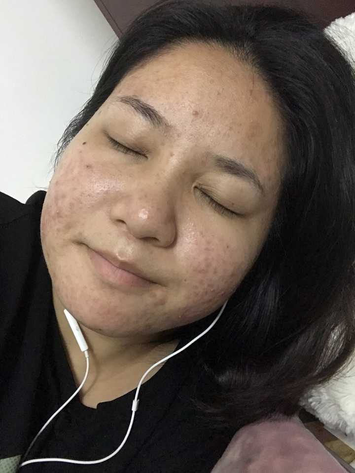 五官好看,皮肤差是种怎样的体验?