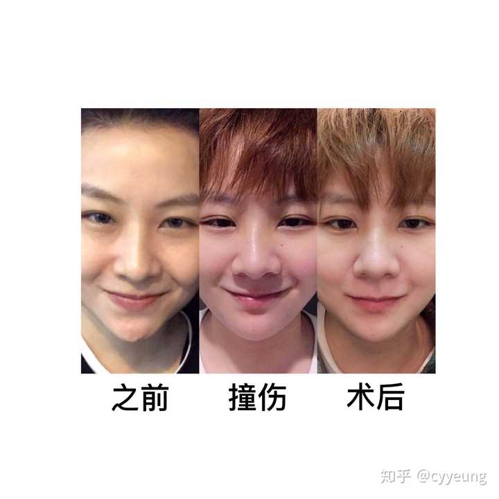 鼻骨骨折消肿后的复位是怎样进行的 如何矫正 知乎