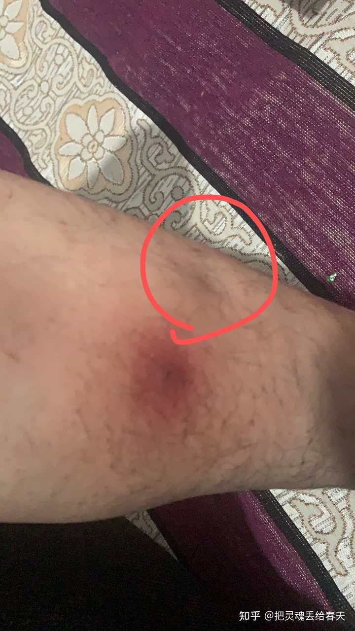 一个火疖子能大到什么地步 知乎