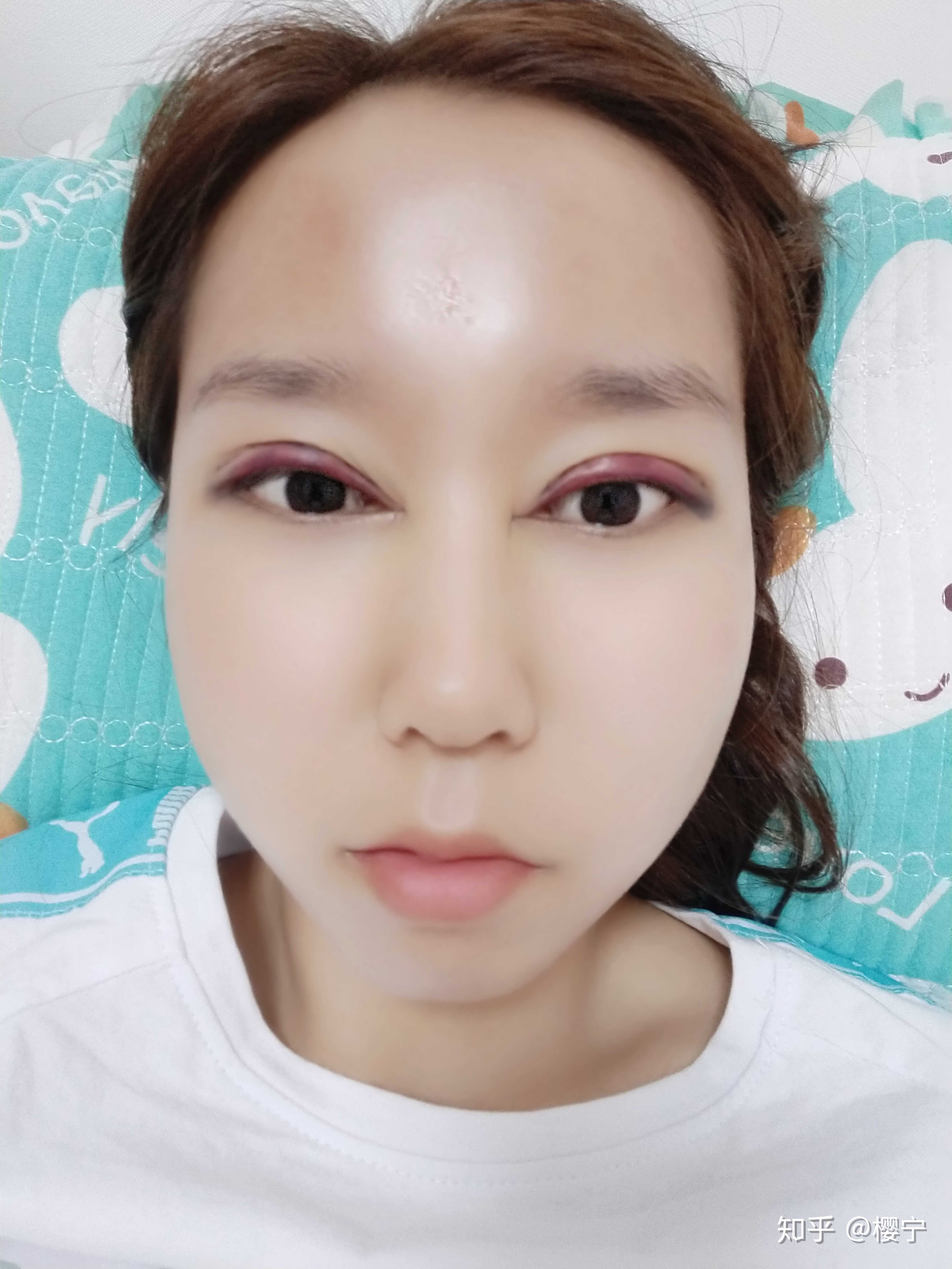樱宁 的想法: #双眼皮手术记录# 第一天 - 知乎