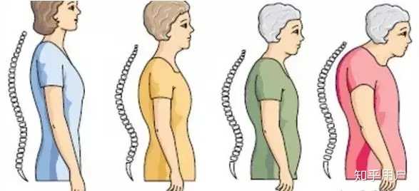 成年人日常如何矫正驼背?? - 知乎