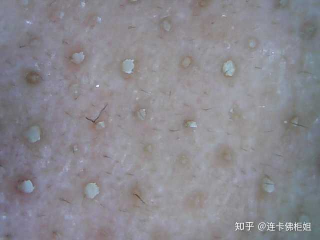 皮肤检测仪下面可以清晰的看到毛孔里的油脂粒