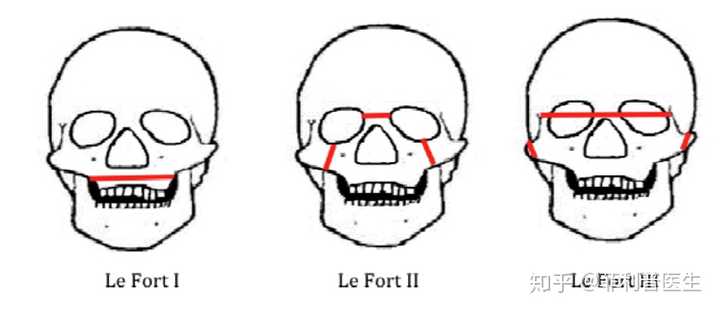 最后科普一下面部le fort骨折的分型