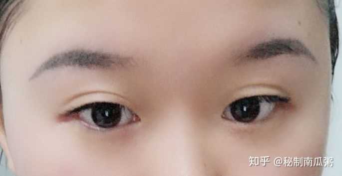 长期戴眼镜,眼睛成了"死鱼眼"怎么解决呢?