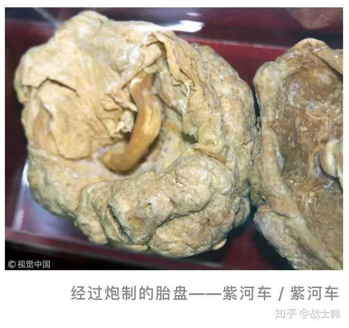 石灰 化 胎盤