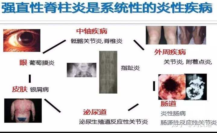 强直性脊柱炎有什么表现