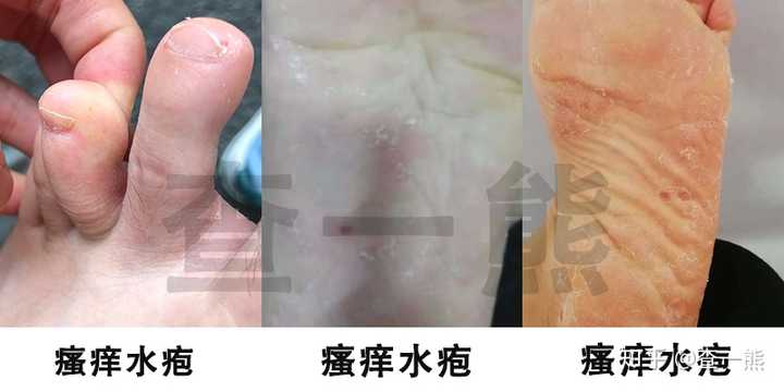 什么是脚气 知乎 什么是脚气 知乎
