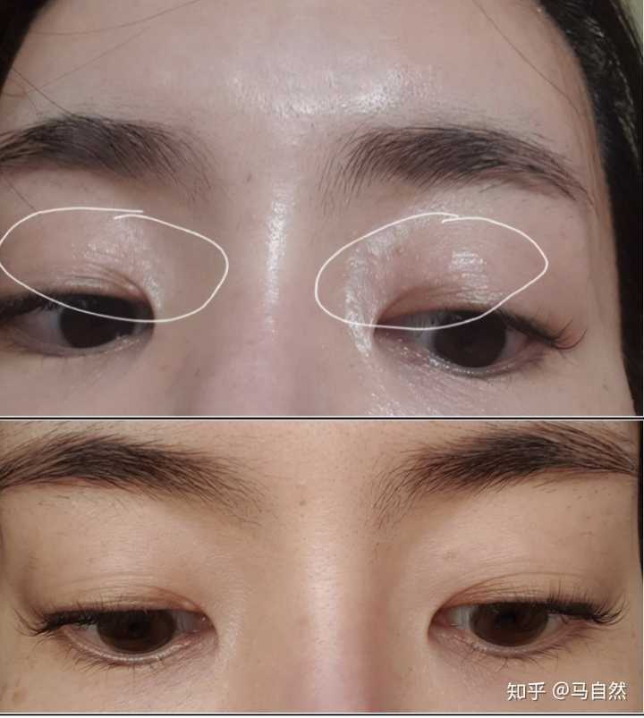 怎么消除眼睛上的脂肪粒 知乎