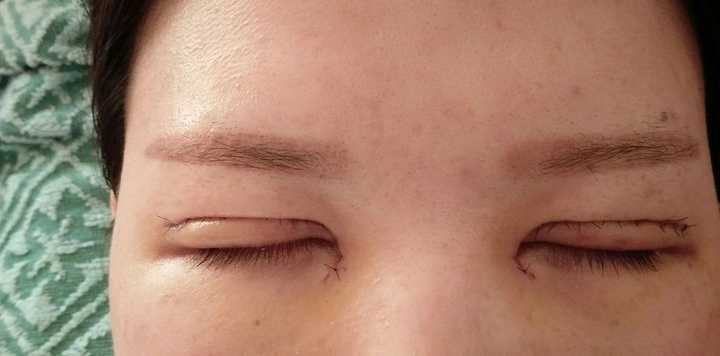 全切双眼皮20多天了,这是肉条还是肿,眼皮很松弛,闭眼后切口上的眼皮