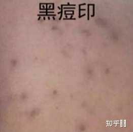 脸上红痘印变成黑色了？ - 知乎