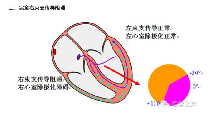 不完全性右束支传导阻滞是怎么回事 知乎 不完全性右束支传导阻滞是怎么回事 知乎