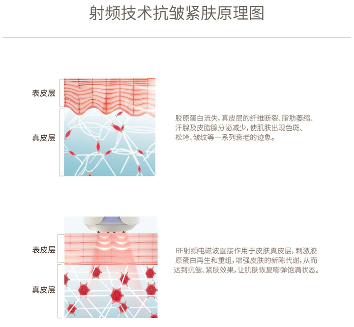 先来了解射频美容的原理,通过射频能量穿透皮肤表皮,直接作用于皮肤