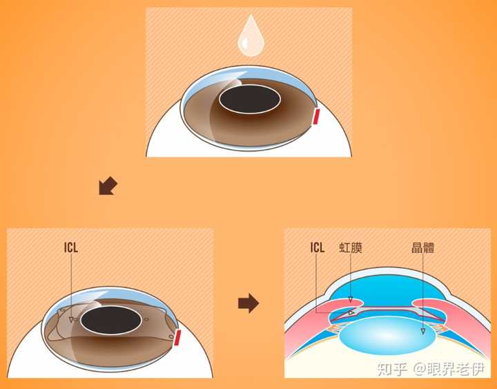 近视手术icl优缺点 知乎