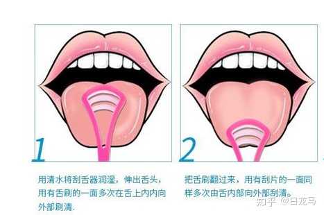 舌刮器能夠清潔舌苔,減少舌背微生物(致臭菌),顯著緩解口臭.