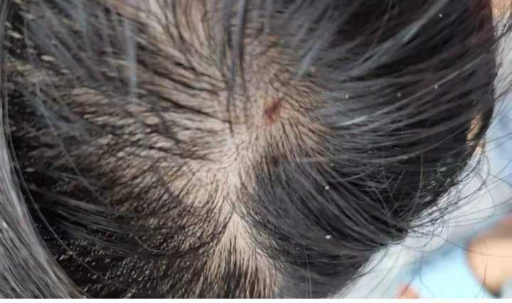 头部脂溢性皮炎，求推荐的洗发水，很多洗发水都过敏？ - 知乎