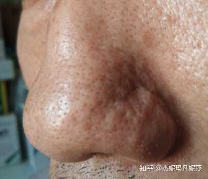 你们去过医院看过黑头吗