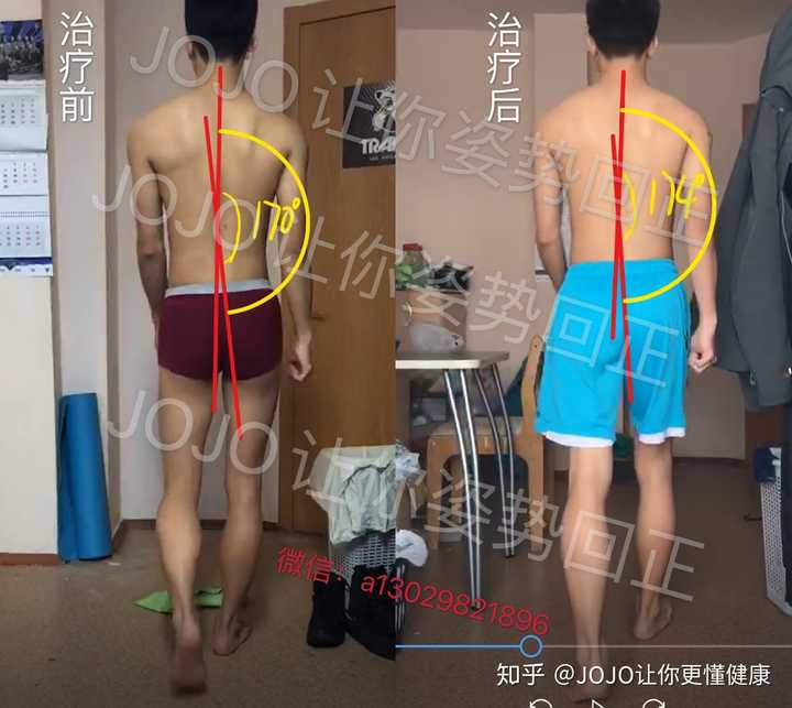 骨盆前倾有矫正成功的例子吗 知乎 骨盆前倾有矫正成功的例子吗 知乎