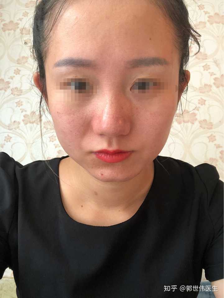 请问有做过鼻骨截骨内推的吗 效果如何 感觉单纯做鼻头鼻翼效果不大 这项手术现在成熟吗 费用大概是多少 知乎 请问有做过鼻骨截骨内推的吗 效果如何 感觉单纯做鼻头鼻翼效果不大 这项手术现在成熟吗 费用大概是多少 知乎