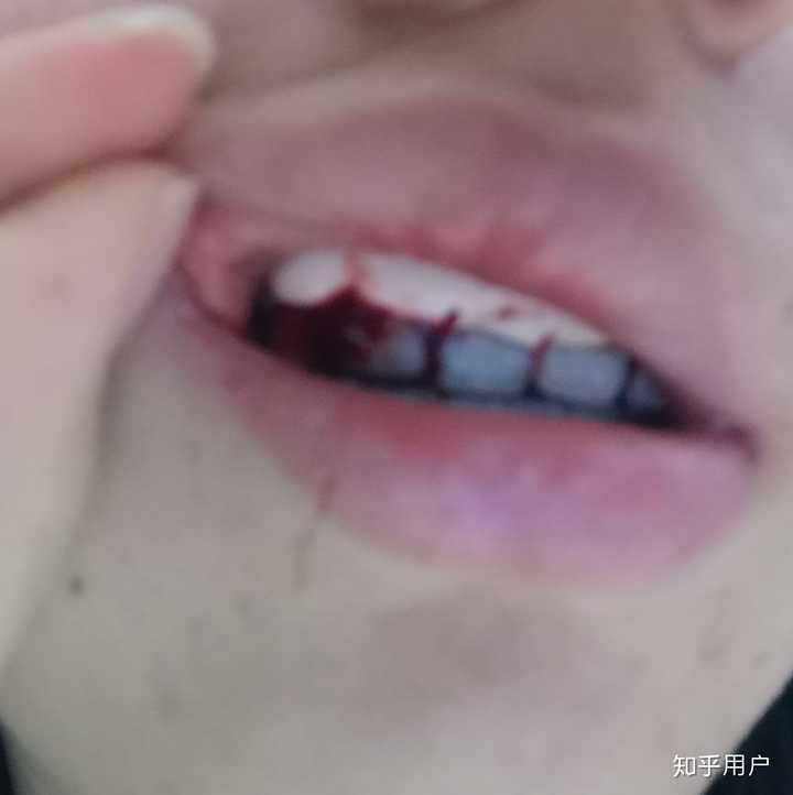 洗牙以后不停流血，张开嘴就是血，怎么止血？