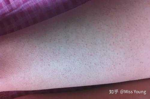 鸡皮肤穿裙子扎头发(鸡皮肤夏天怎么穿裙子)
