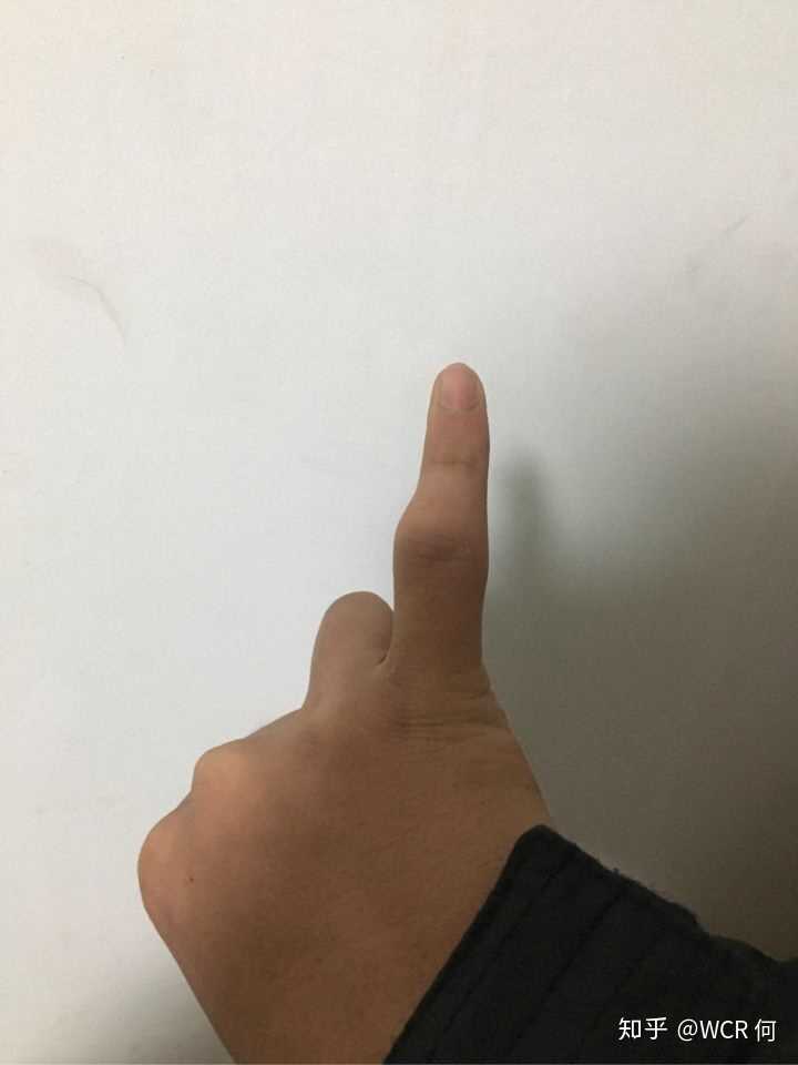 我觉得有疤挺自豪的,爱好玩速降山地车,身上的疤数不胜数,小腿上全部