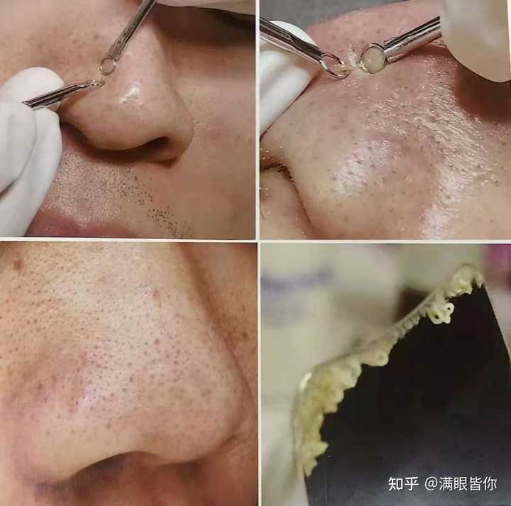 毛孔长摸起来刺刺的拔出来后一条白白硬硬的是什么东西呀 知乎