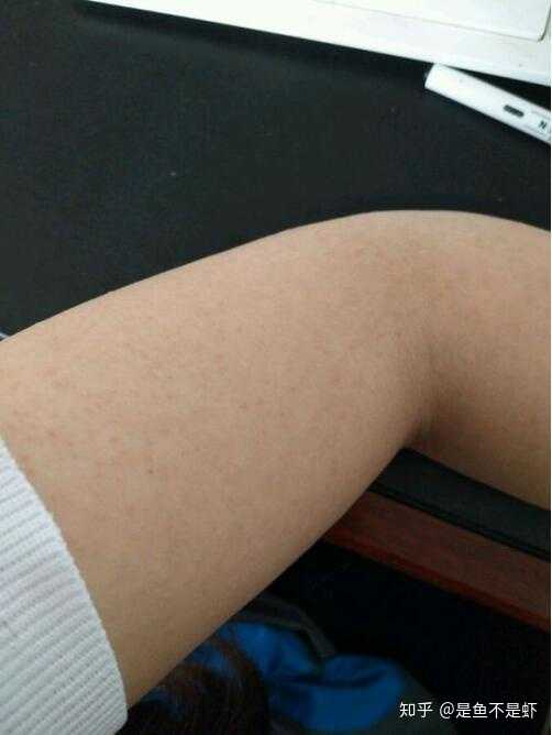 有治鸡皮肤的偏方吗(治鸡皮肤最有效的方法)