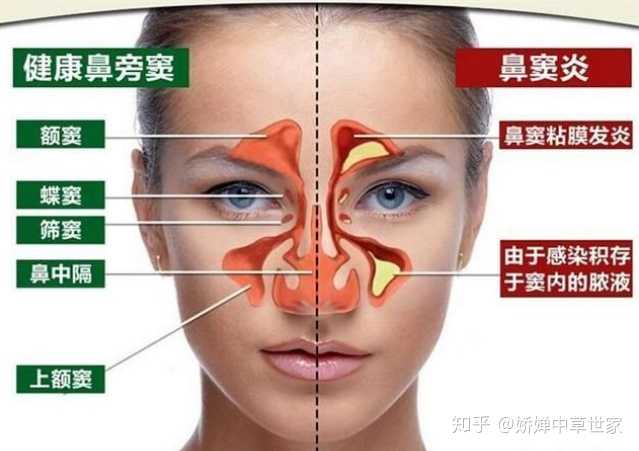 有一些慢性鼻窦炎由于鼻腔内的阻塞性疾病,例如鼻息肉,鼻甲肥大,鼻中