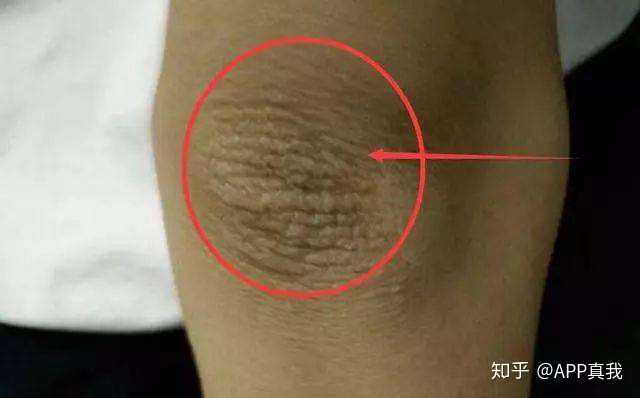 胳膊肘黑 洗澡搓不掉怎么办 知乎