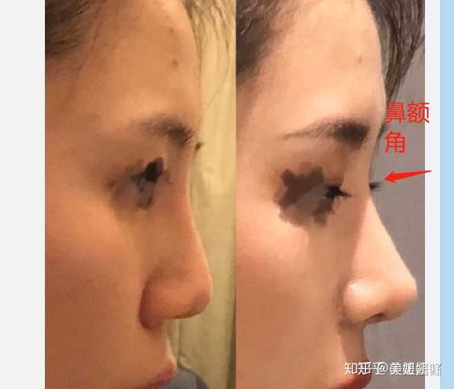 做鼻综合是什么体验 知乎