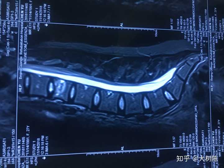 腰椎骨折是怎样的体验 治疗过程是怎样的 多久可以恢复 知乎