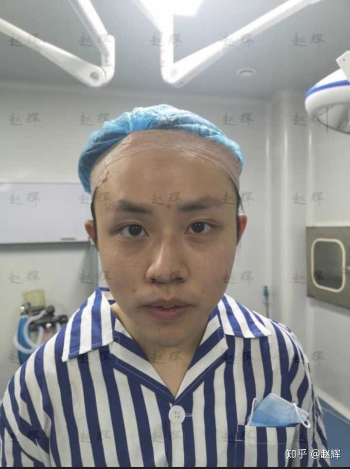 眼睛丑,眉骨低,额头和眉弓凹陷,该怎么办呢?