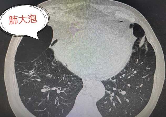 肺泡真实图片图片